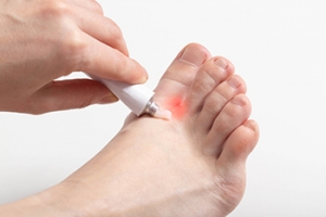 Athlete&#039;s Foot or Dry Skin?