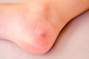 Understanding and Managing Foot Blisters