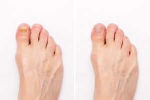 White Superficial Onychomycosis and Other Nail Infections
