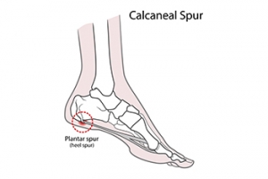 Can Exercises Help Heel Spurs?
