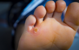 Orthotics May Help to Treat Corns and Calluses