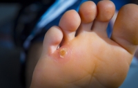 Orthotics May Help to Treat Corns and Calluses