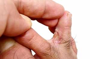 Athlete&#039;s Foot May Be Linked to Hygiene