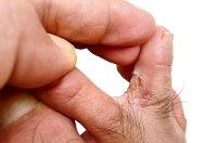 Athlete's Foot May Be Linked to Hygiene