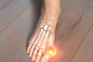 Bunions and Relief Methods