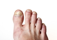 Reasons Why Toenail Fungus May Develop